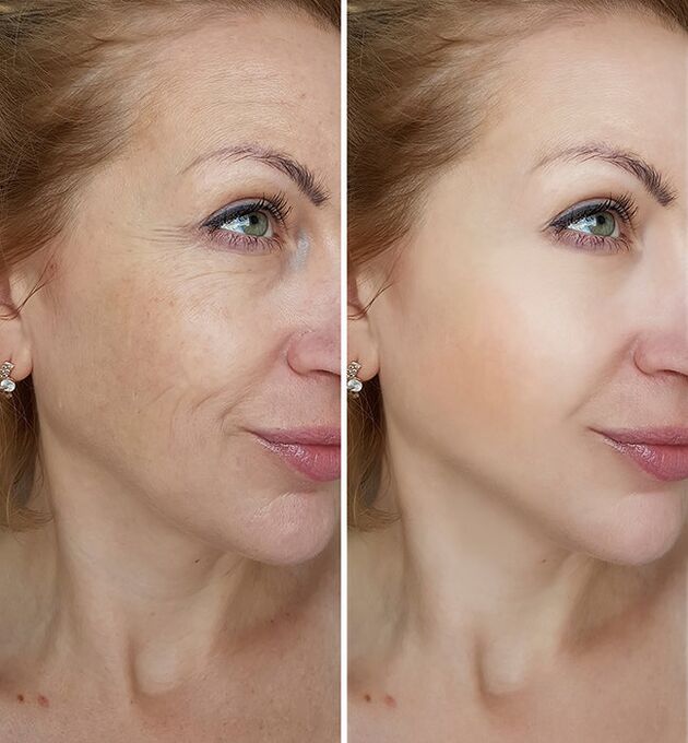 antes e depois