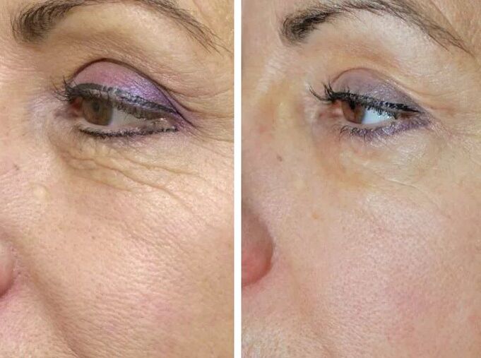 Laser de campo antes e depois