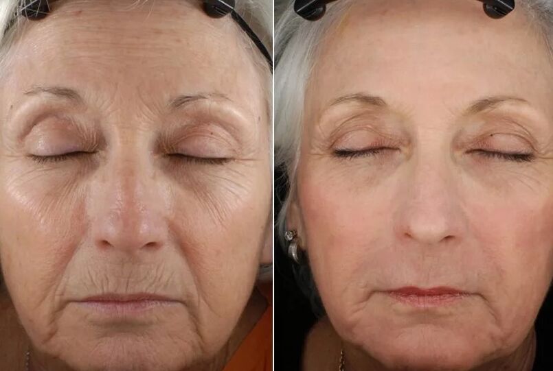 Os resultados do rejuvenescimento fracionário